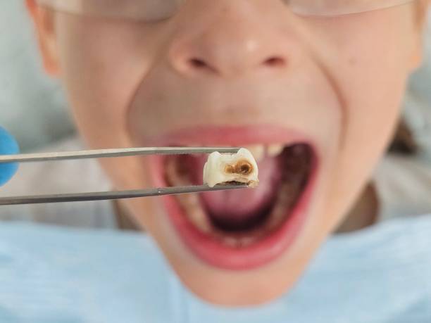 Best Emergency Dental Extractions in Morehead City, NC